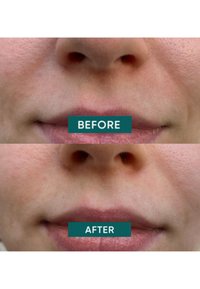 Apricot Beauty HYALURON MOUTH PATCHES - Masker - beige