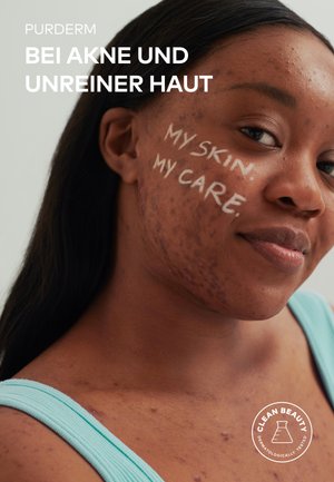 Young woman with acne and scars on cheek and shoulder, with "MY SKIN. MY CARE." written on her cheek, promoting skincare for acne.