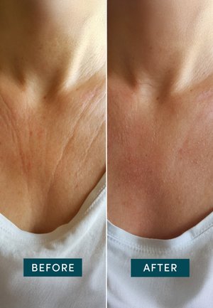 Uvrstitev 16: Apricot Beauty - REUSABLE DÉCOLLETÉ PAD HYALURON - Maska za obraz