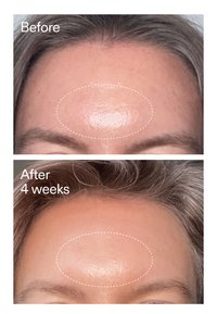 Close-ups van het voorhoofd voor en na 4 weken tonen verminderde glans en een gladdere huidstructuur binnen een omlijnd gebied.