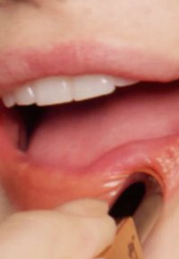 Primo piano di una bocca con denti bianchi e labbra rosa, che mostra una lingua e uno strumento parzialmente inserito nella bocca. Texture liscia visibile.