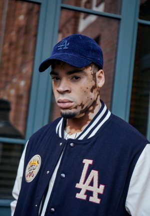 Ung mand med vitiligo iført en blå LA Dodgers kasket og varsityjakke, stående foran et vindue med en murstensvæg i baggrunden.