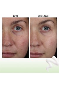 Immagini prima e dopo della pelle. A sinistra si osservano arrossamenti e una texture irregolare; a destra si nota un tono migliorato e un aspetto più liscio dopo 4 settimane.