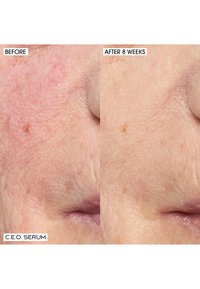 Porównanie stanu skóry przed i po. Po lewej: czerwona, nierówna tekstura; po prawej: gładszy, jaśniejszy odcień z redukcją widoczności drobnych linii i niedoskonałości.