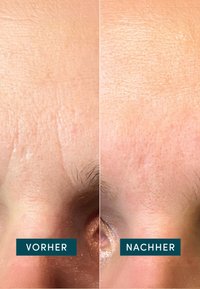 Gros plan de la peau sur le front, montrant deux côtés étiquetés "Vorher" et "Nachher". Le côté gauche présente des rides visibles ; le côté droit semble plus lisse.