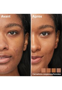 Comparaison des résultats de traitement de la peau : à gauche, texture inégale et acné, à droite, peau lisse avec ton uniforme ; teintes pour les teintes de peau moyenne à foncée ci-dessous.