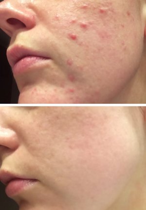 Delt bilde som viser hudtekstur før og etter behandling. Øverste halvdel viser akne og rødhet; nederste halvdel viser klarere, jevnere hud.