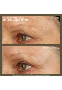 Comparaison avant-après de la peau autour de l'œil, montrant une réduction des ridules et une texture plus lisse après 12 semaines d'utilisation.