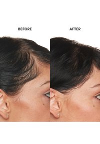 Confronto del trattamento per capelli prima e dopo. Il lato sinistro mostra capelli più sottili alla tempia; il lato destro mostra capelli più folti e dall'aspetto più sano.