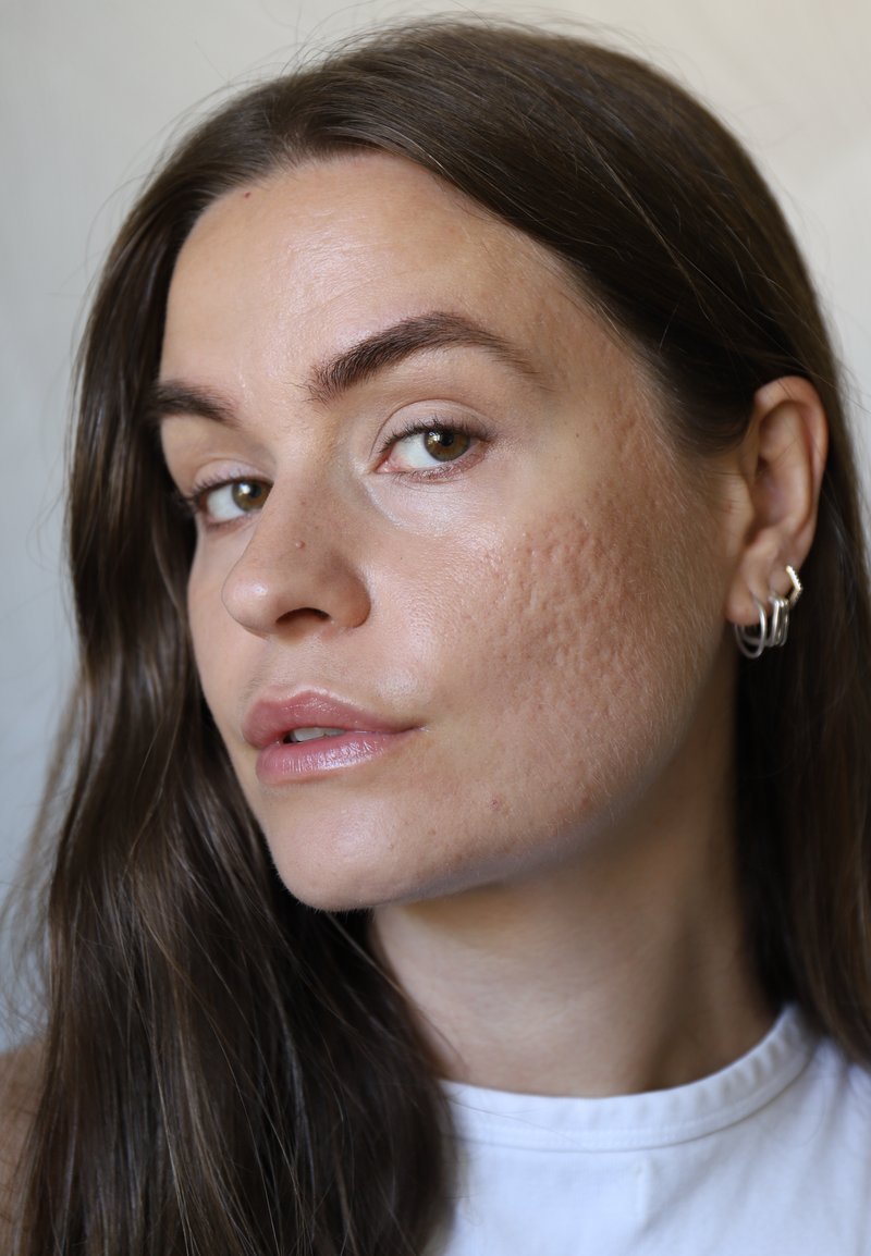 Jeune femme aux longs cheveux bruns montrant des cicatrices d'acné sur sa joue droite, portant de petites boucles d'oreilles anneaux et un haut blanc.